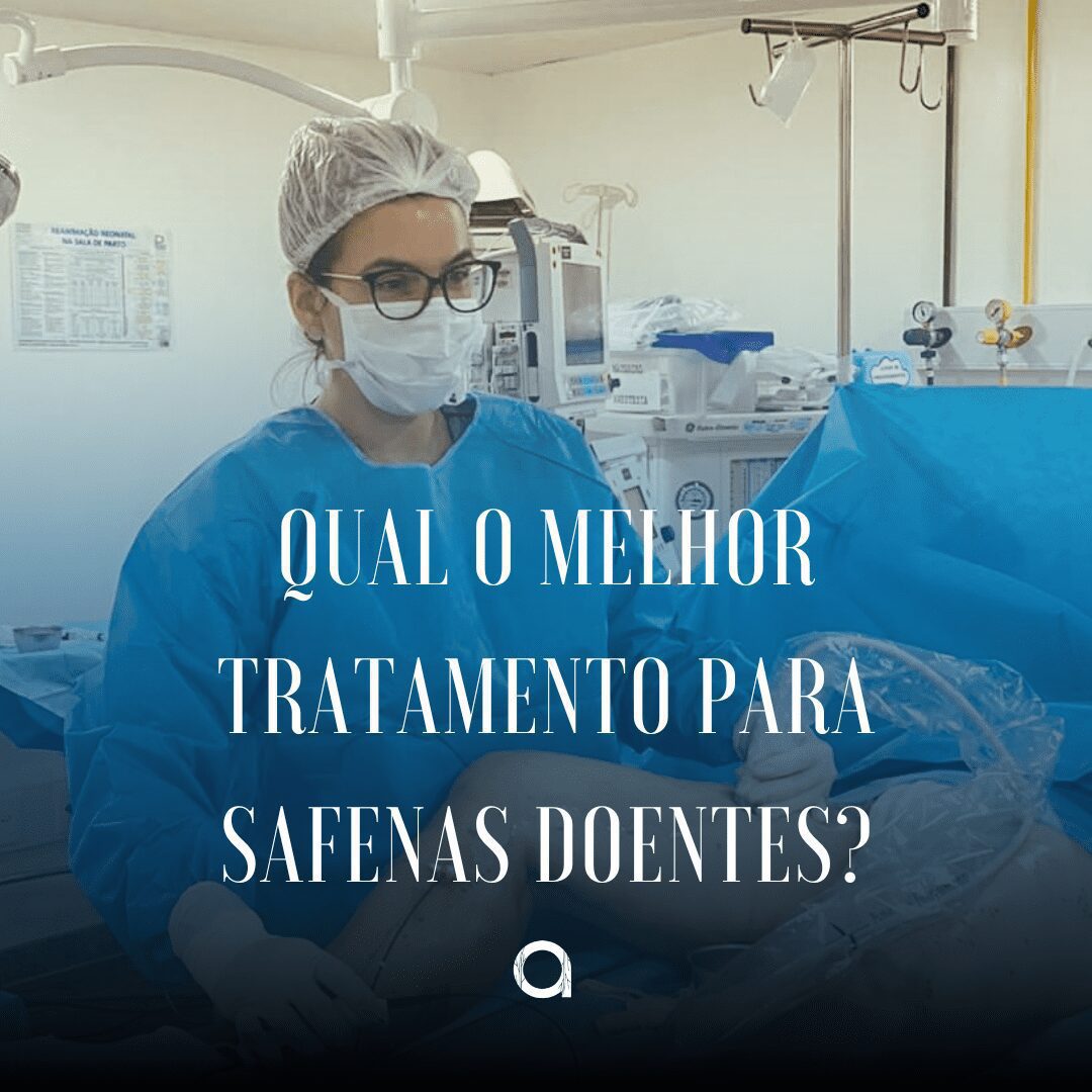 Qual O Melhor Tratamento Para Safenas Doentes Dra Catarina Almeida