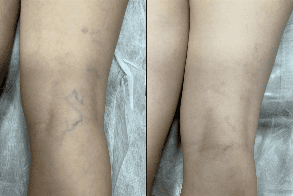 Veia após escleroterapia com espuma, 6 meses de evolução, Recife