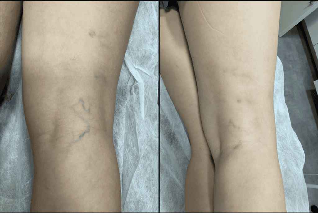 Veia após escleroterapia com espuma, 30 dias de evolução, Recife