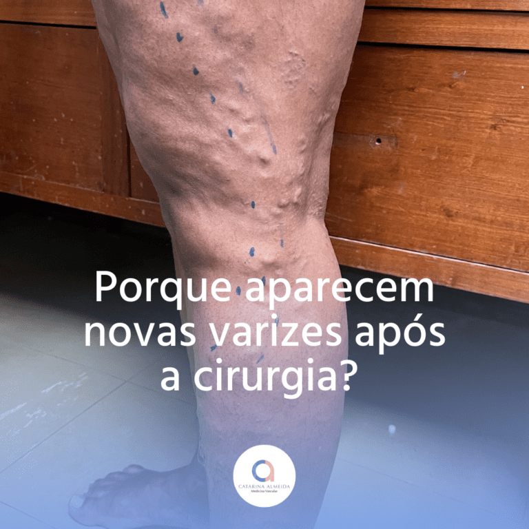 Varizes Após A Cirurgia: Qual A Causa? – Dra. Catarina Almeida