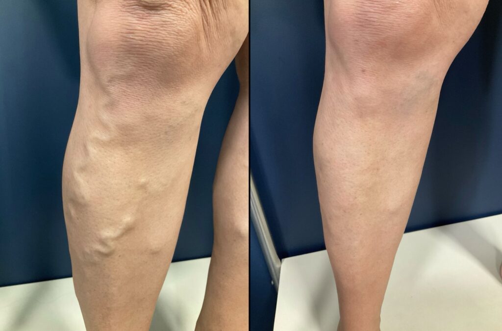Imagem de antes e depois de tratamento de varizes. À esquerda, perna com veias dilatadas e salientes; à direita, mesma perna com aparência mais uniforme