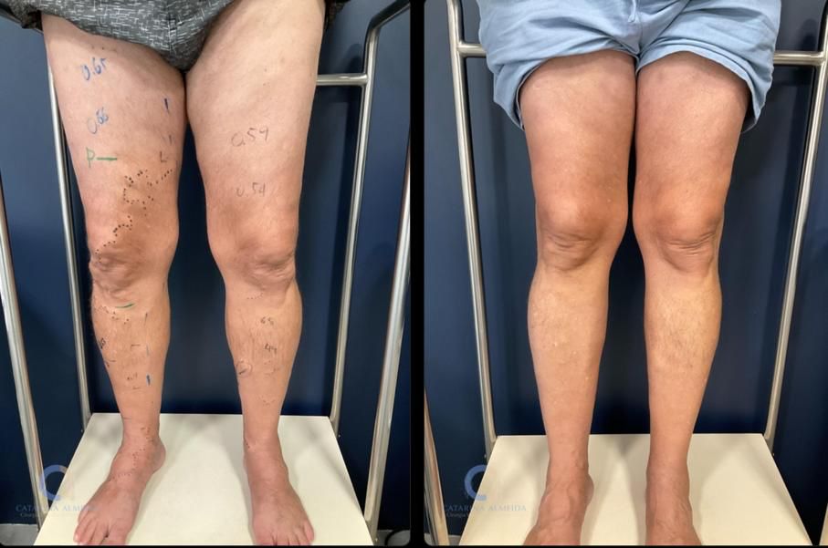 Foto de antes e depois do tratamento de varizes em uma paciente. À esquerda, as pernas apresentam marcas de caneta para mapeamento das veias; à direita, após o tratamento, a pele está mais uniforme e sem sinais visíveis de varizes.