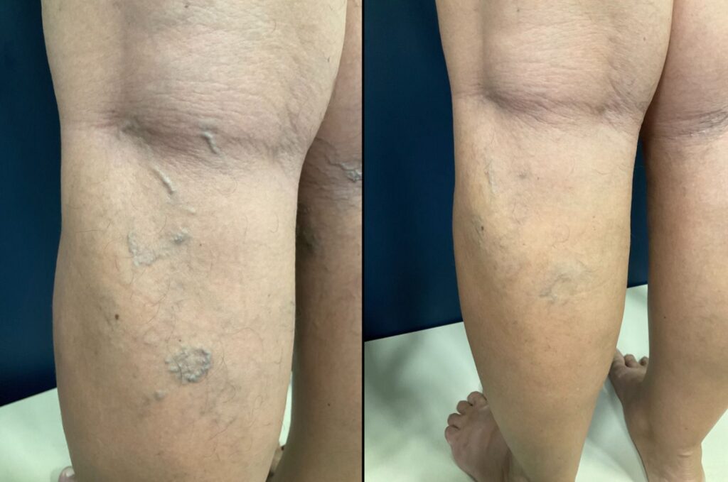 Duas pernas femininas com varizes grossas na imagem à esquerda e aparência significativamente melhorada na imagem à direita, após tratamento