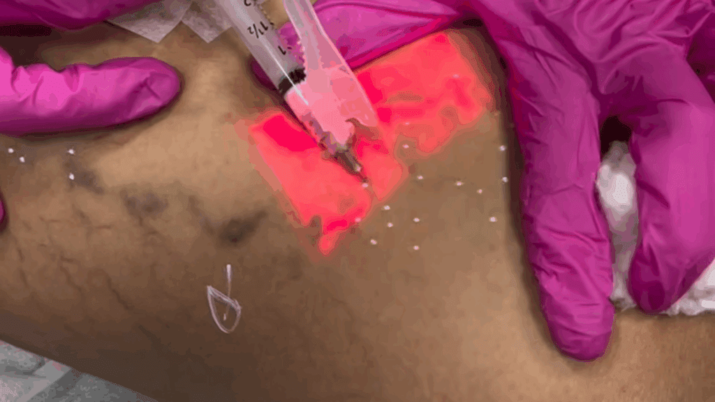 Mãos com luvas rosas realizam aplicação de espuma em veia da perna usando seringa, com auxílio de transiluminação em luz vermelha para guiar o procedimento.