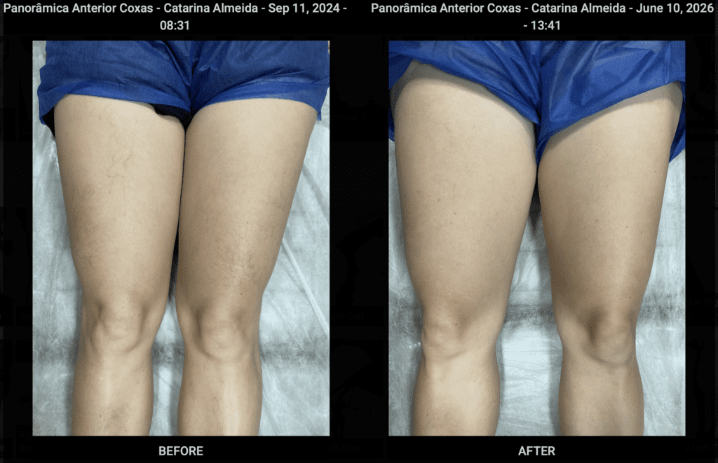 Fez cirurgia de varizes e as veias continuam ali? Entenda o que causou essa frustração e conheça o tratamento moderno de varizes a laser em Recife que resolve o problema sem cirurgia hospitalar.