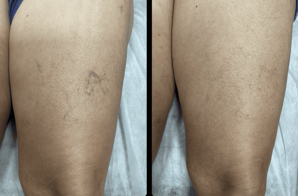 Foto antes e depois de telangiectasias.