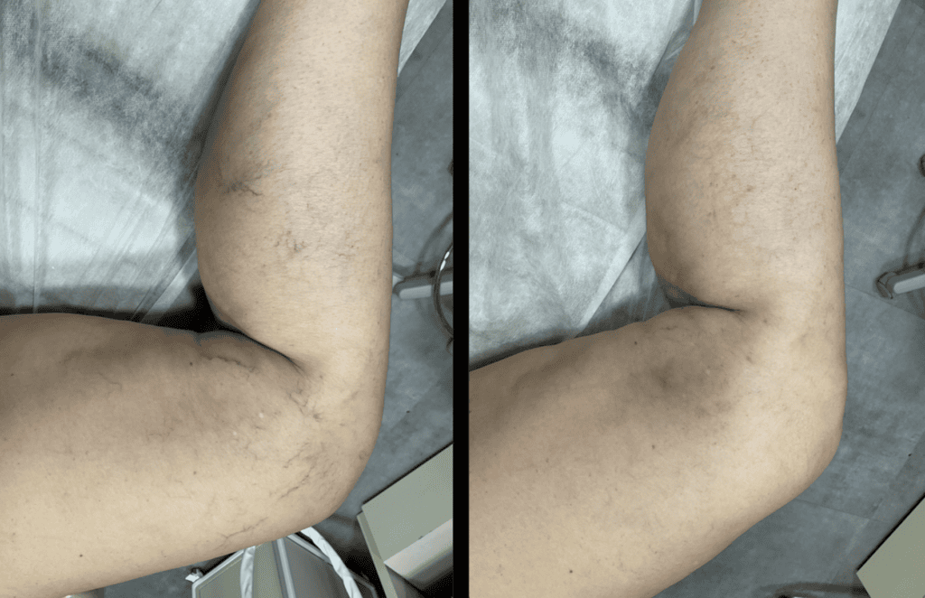 Foto antes e depois mostrando vasos em face interna de coxa.