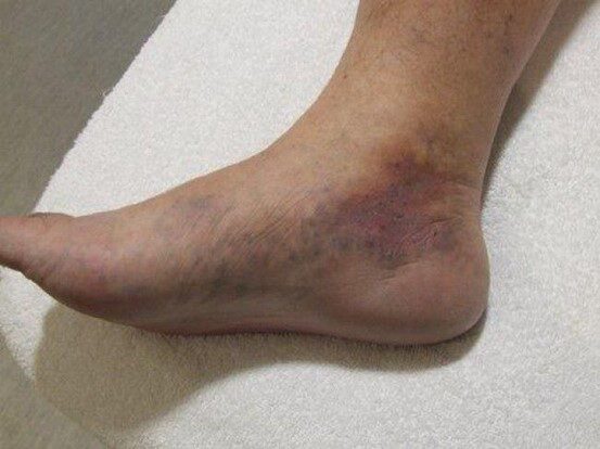 Dermatite ocre e eczema de estase.