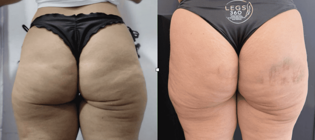 Antes e depois imediato de bioestimulador e subincisão.